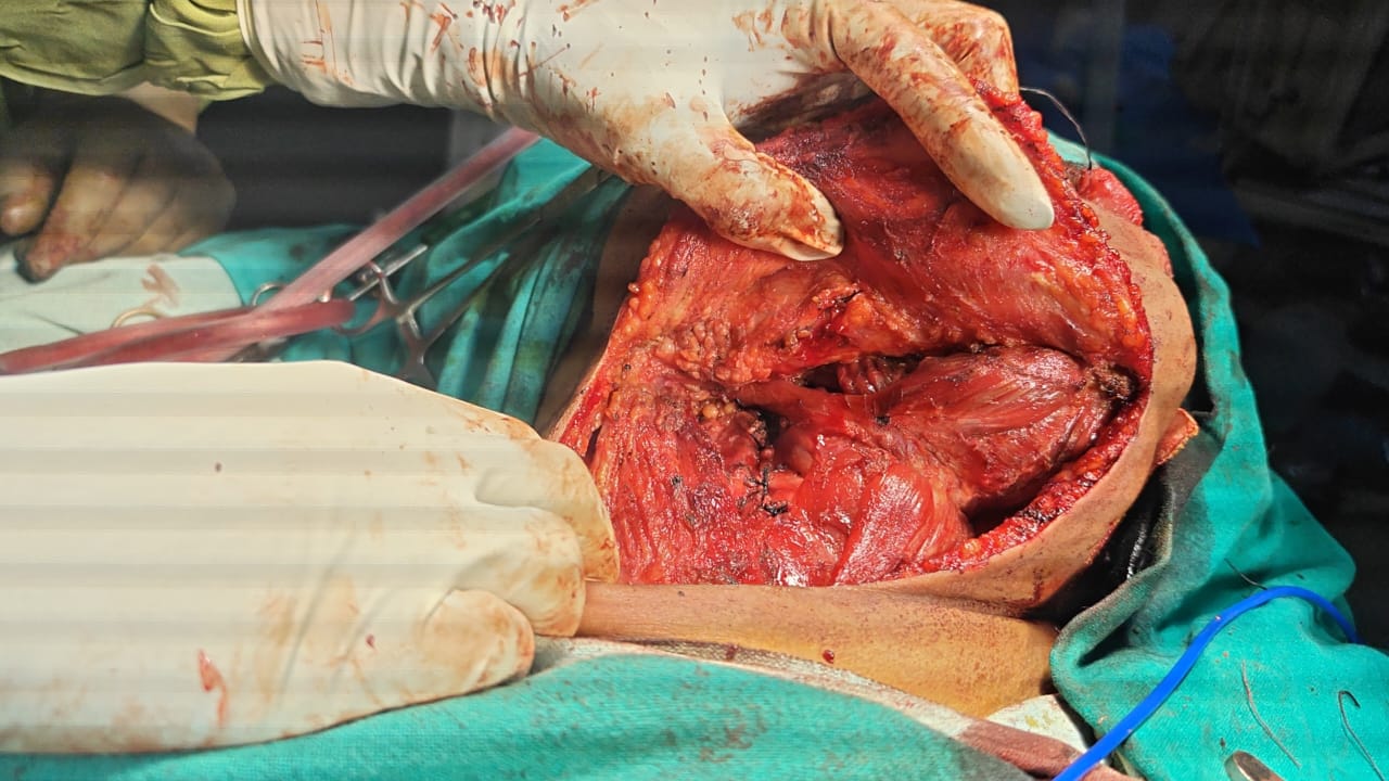 CA Tongue with neck node dissection image 1