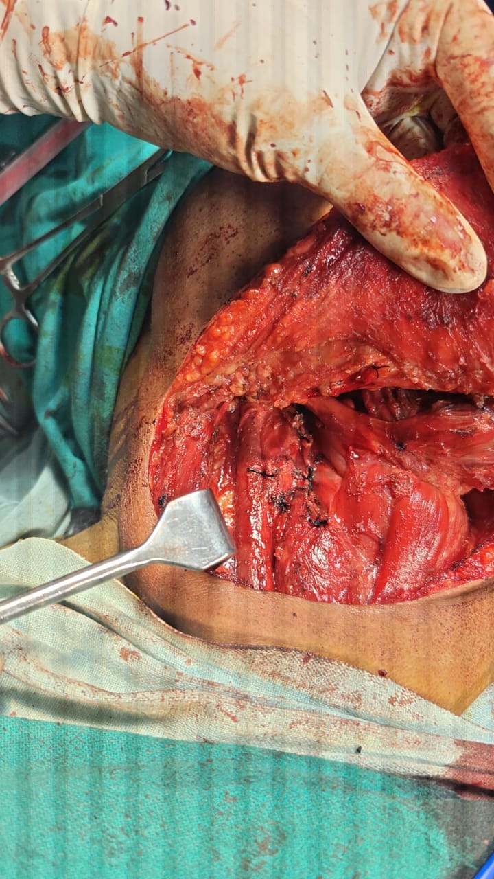 CA Tongue with neck node dissection image 3
