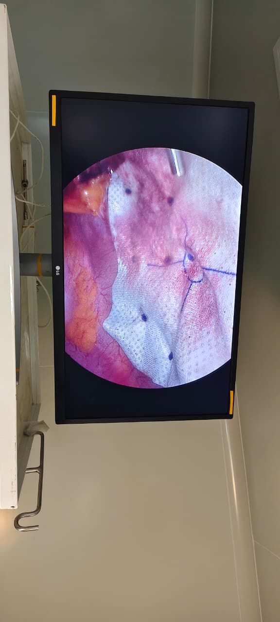 Bariatic sleeve gastrectomy image 1