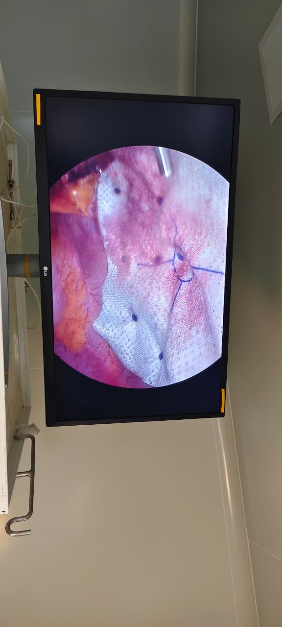 Bariatic sleeve gastrectomy image 2