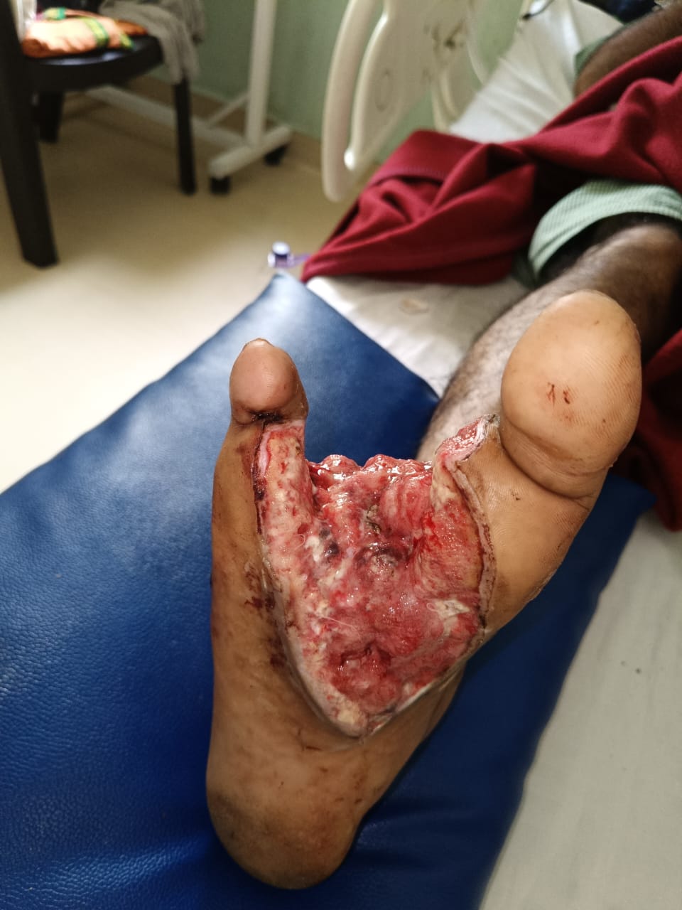 Diabetic foot with plastic surgery repair image 1