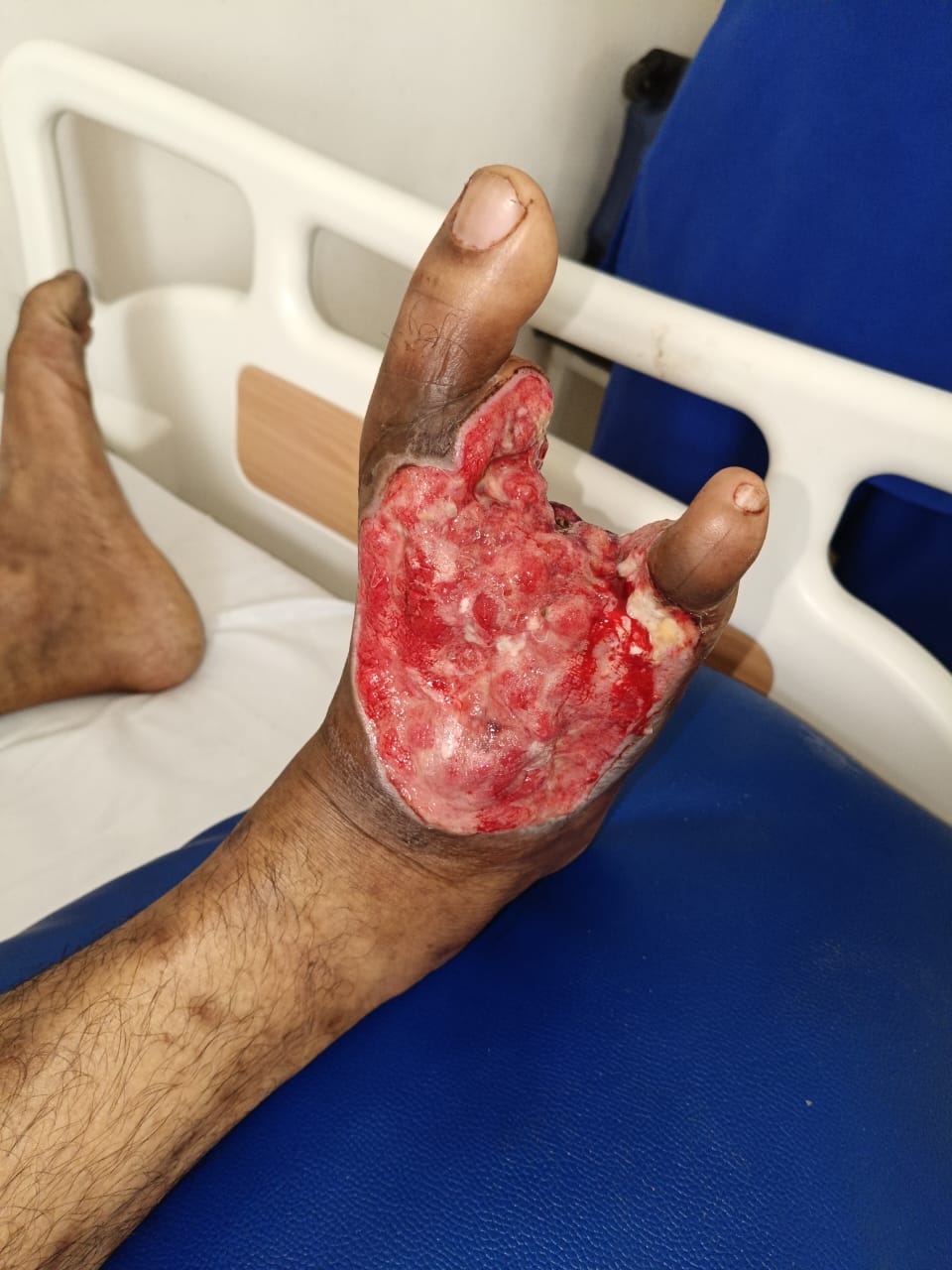Diabetic foot with plastic surgery repair image 4